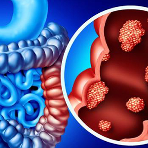 gastric cancer illustration